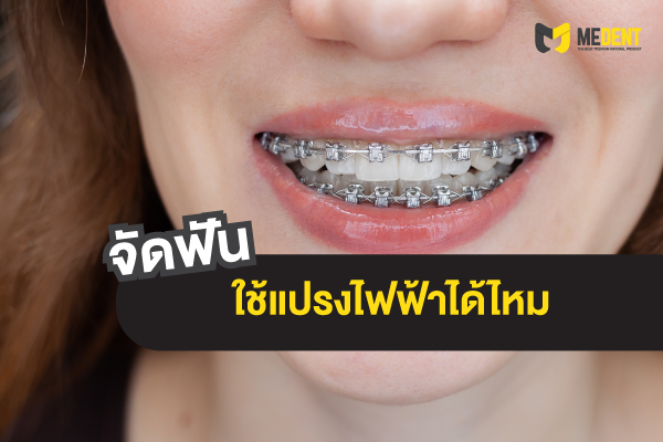 จัดฟันใช้แปรงไฟฟ้าได้ไหม