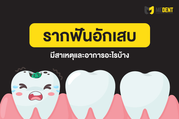 รากฟันอักเสบ มีสาเหตุและอาการอะไรบ้าง 