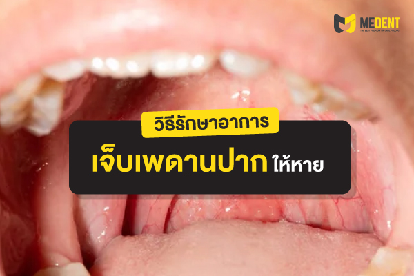 วิธีรักษา เจ็บเพดานปาก